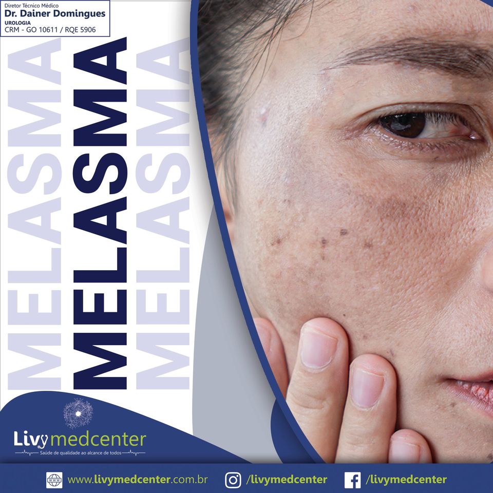 Melasma