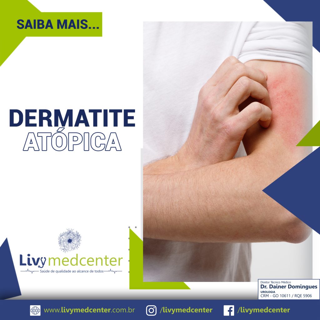Dermatite Atópica