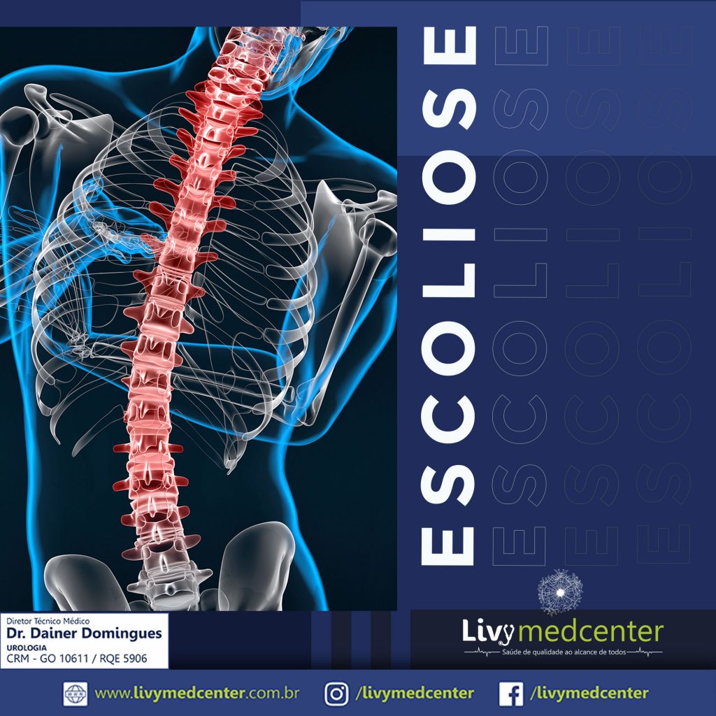 Escoliose