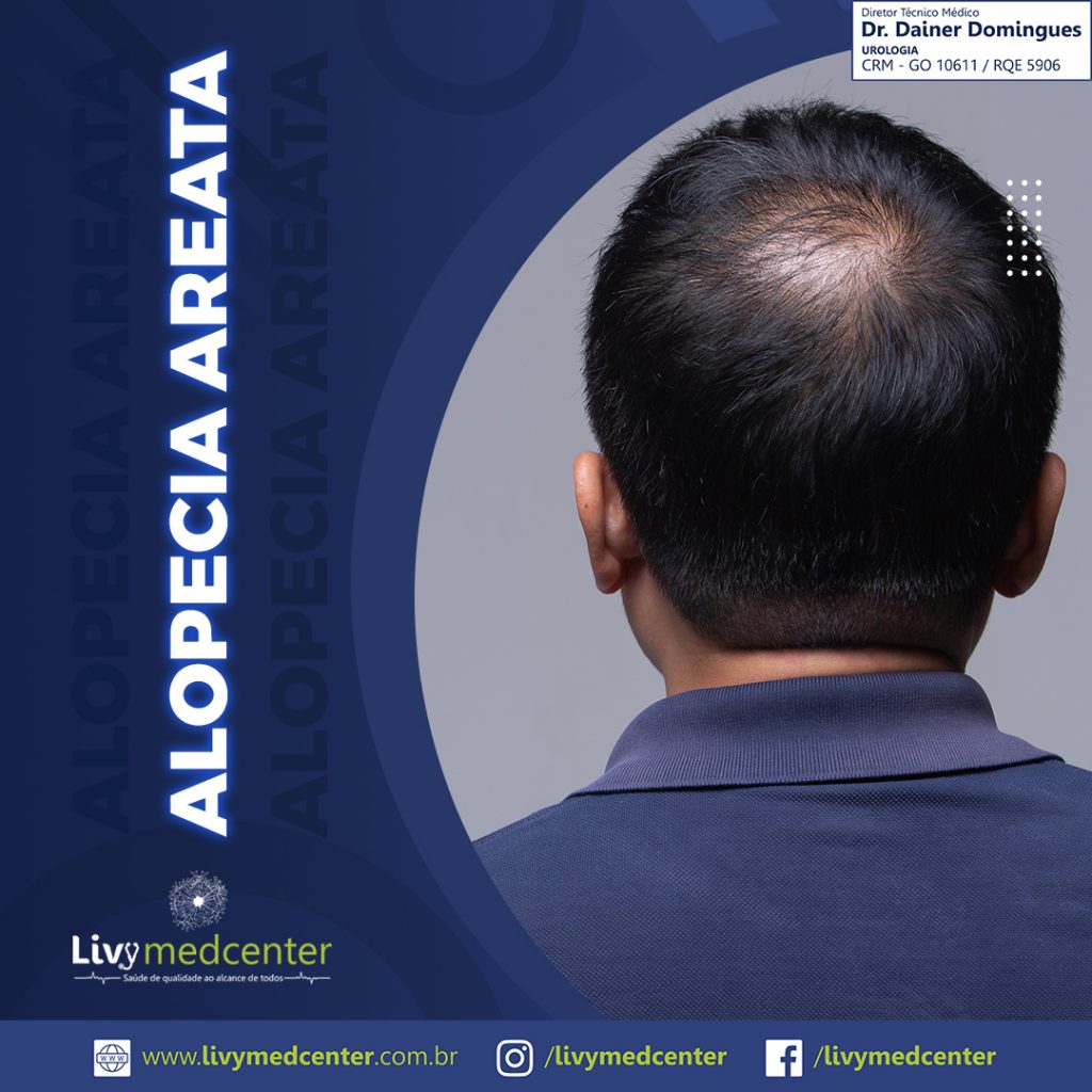 Alopecia Areata