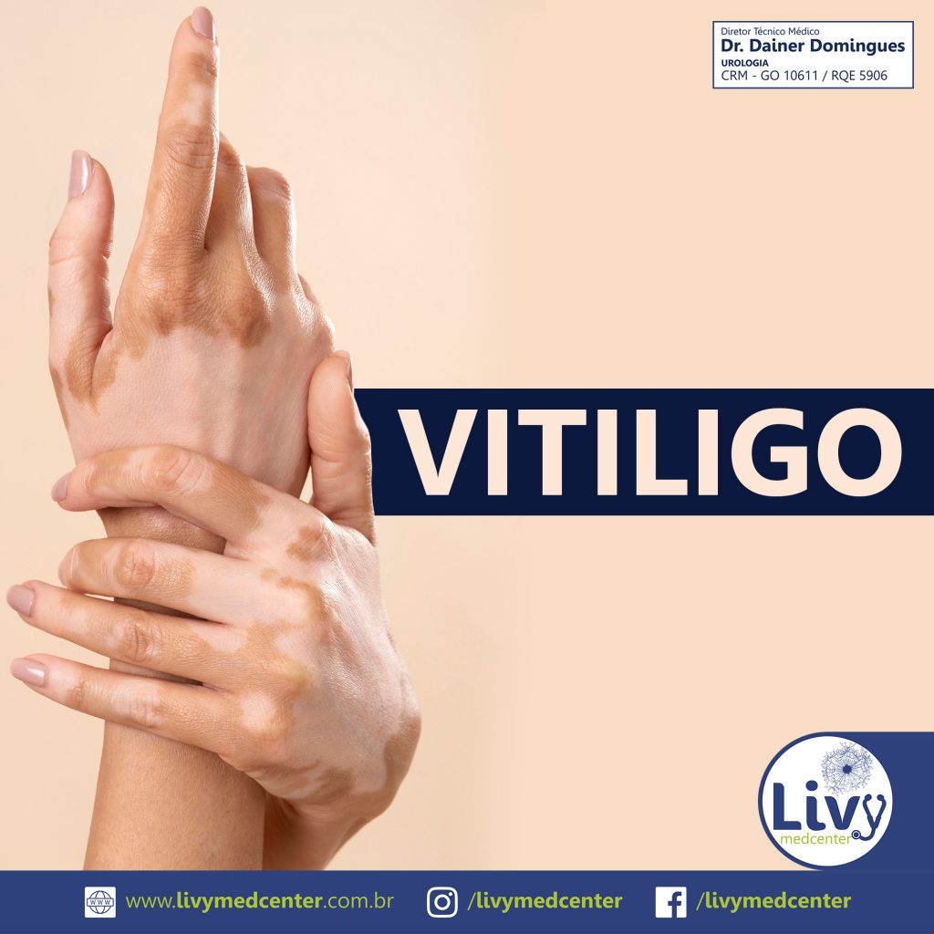 Vitiligo
