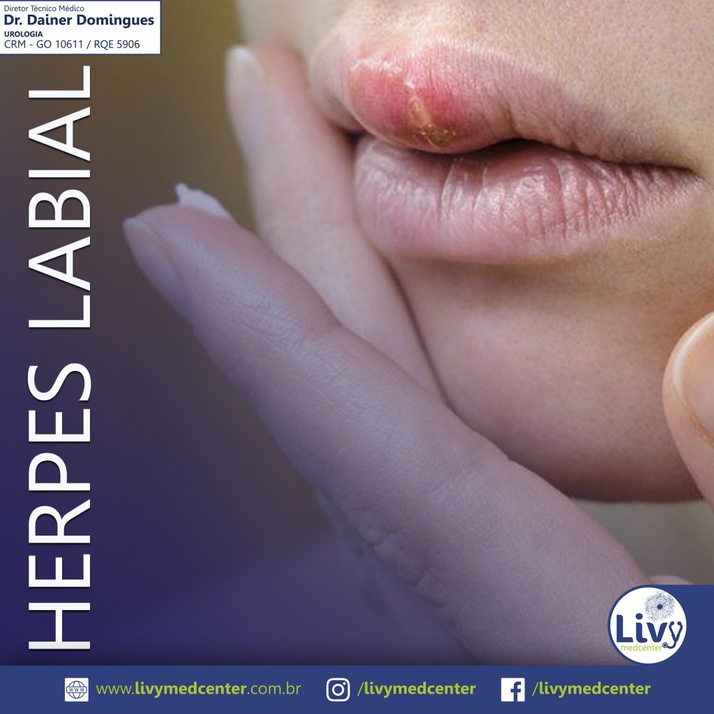 Herpes Labial