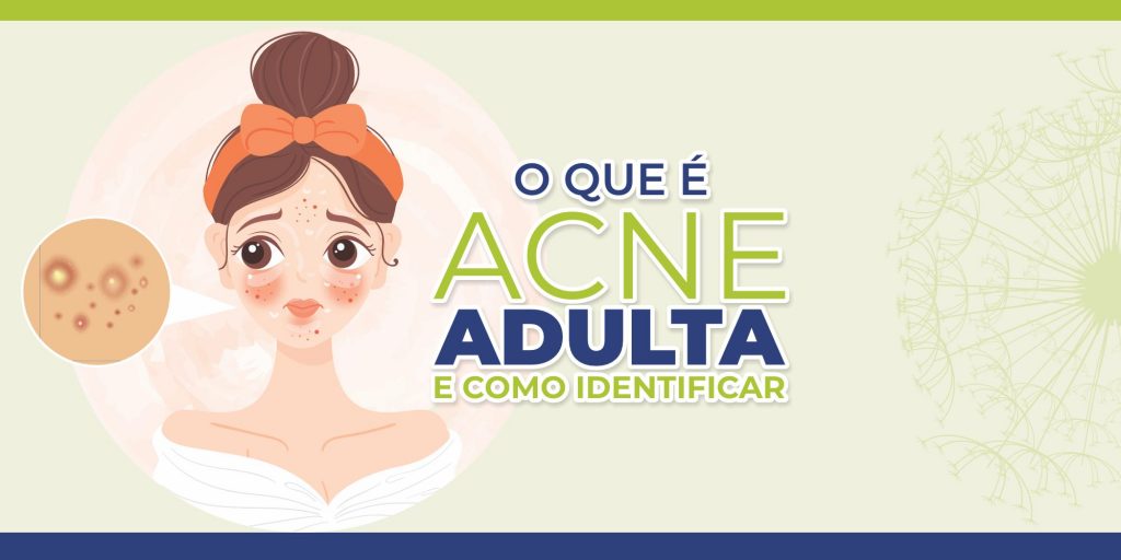 O que é ACNE adulta e como identificar