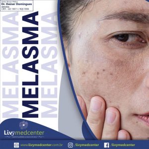 Melasma