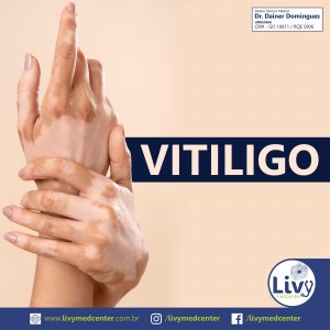 Vitiligo